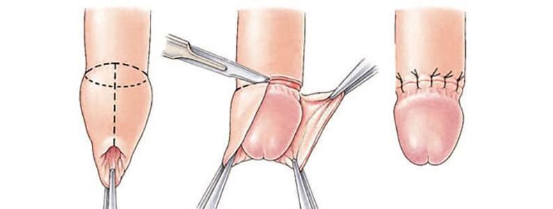 Effects of circumcision on penis size