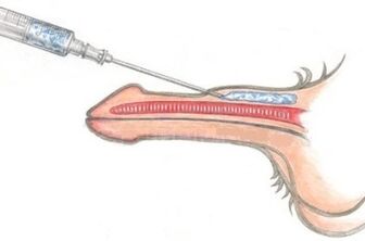 The Dangerous Way to Use Vaseline Injections to Enlarge Your Penis